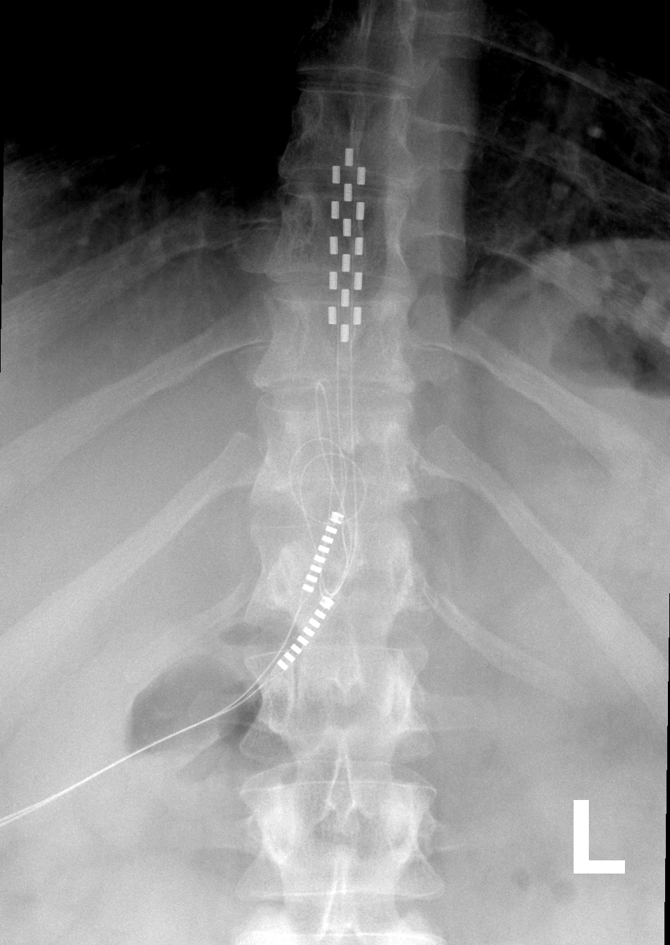 spinal cord stimulator implant